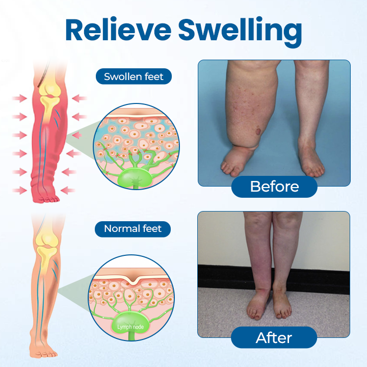 Mayo Clinic recommends👨‍⚕️: Lymphora Swelling Relief Roll-On