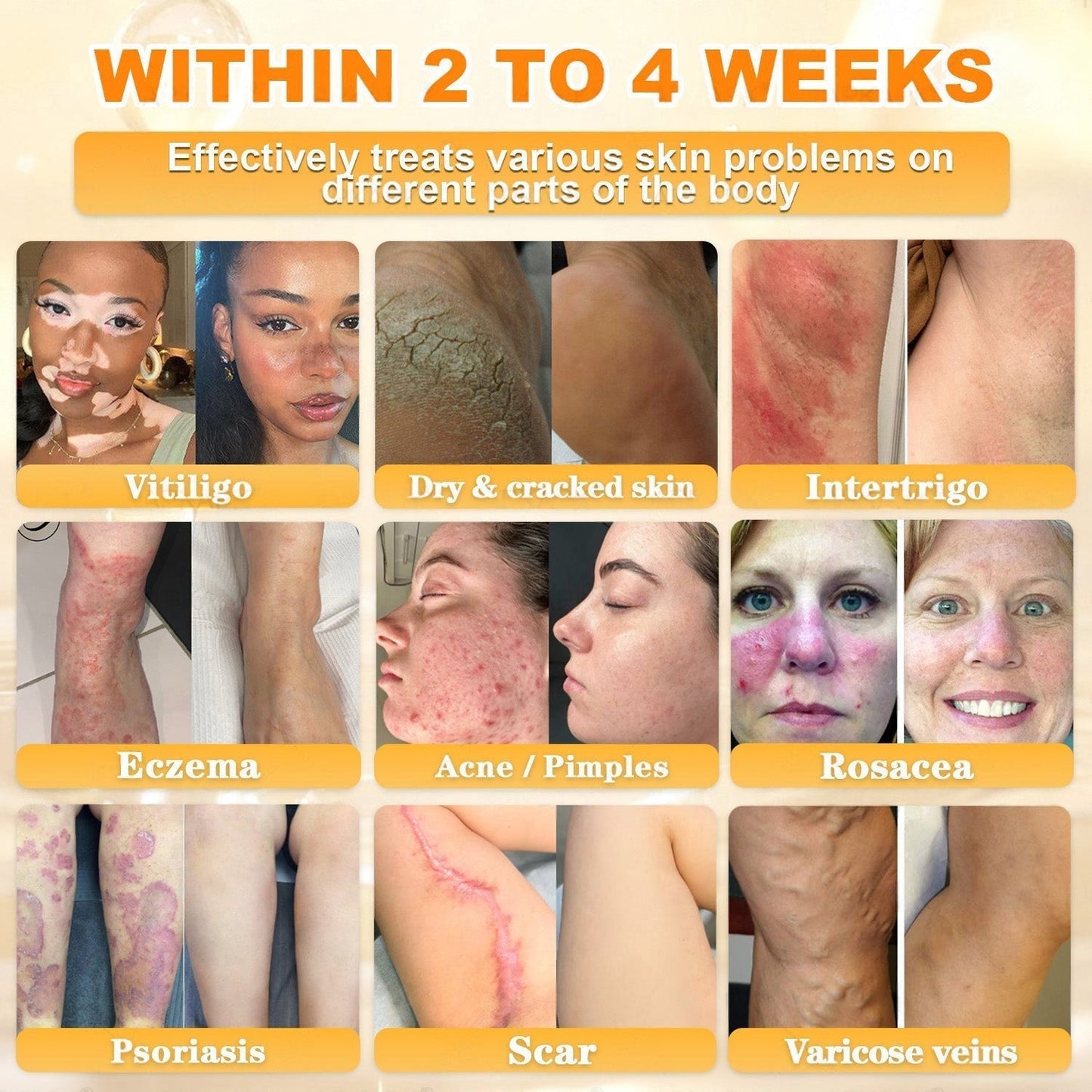 🐝🔥FDA Approved| Ptyalial® Bee toxin Skin Restoration Cream (Anti-aging, Hydrating, Skin Repair, Even Tone, Acne and Dark Spot Treatment, Wart and Mole Removal, Psoriasis Relief)