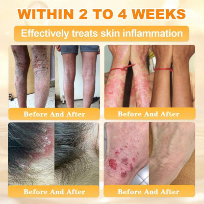 🐝🔥FDA Approved| Ptyalial® Bee toxin Skin Restoration Cream (Anti-aging, Hydrating, Skin Repair, Even Tone, Acne and Dark Spot Treatment, Wart and Mole Removal, Psoriasis Relief)