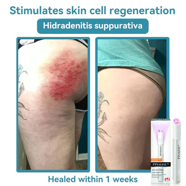 ✨Ptyalial™ All-in-One CO₂ Laser Eraser Pen | Removes Moles, Warts, Skin Flaws & Pigmentation