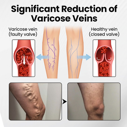 Ptyalial® Leg Vein Magnet Ankle Bracelet